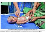 India: Rahul, un bimbo di soli due mesi prende fuoco, gli altri casi nel mondo, perchè accade