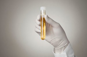 Test-urine-permette-diagnosi-precoce-del-tumore-al-pancreas