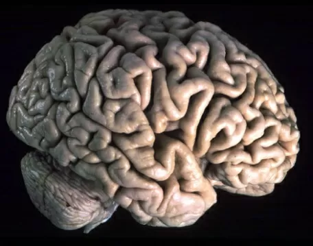 Tumore-al-cervello-la-cura-può-provenire-da-proteina-più-attiva-nelle-donne