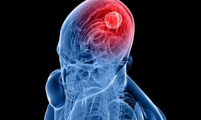 Tumore al cervello una proteina riduce il rischio di cancro nella donna