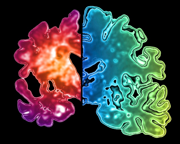 Alzheimer-a-rischio-è-chi-utilizza-sedativi-contenenti-benzodiazepine