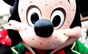 Morbillo-psicosi-per-epidemia-a-Disneyland-in-California