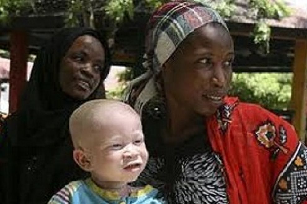 Tanzania, mutilato bambino albino di un anno per stregoneria