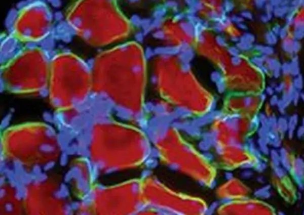 Sla-risultati-positivi-da-cura-con-cellule-staminali