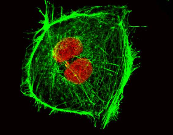 Tumori, scoperta proteina amica delle neoplasie che provoca le metastasi