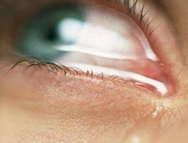 Glaucoma 1 milione di italiani colpiti ma la metà non lo sa
