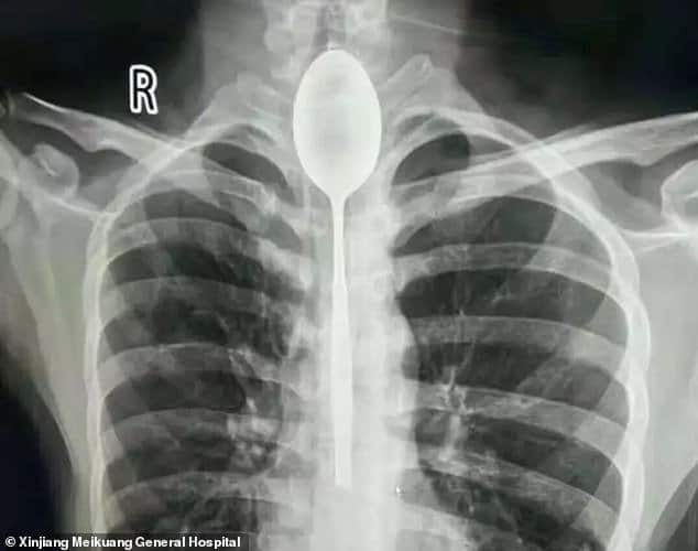 Uomo ingoia per una scommessa un cucchiaio di metallo che per un anno rimane bloccato nel suo esofago