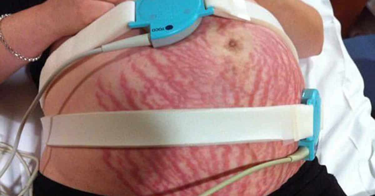 Giovane donna alla 30esima settimana di gravidanza si ricopre di macchie rosse, i medici non hanno coraggio di dirle la verità