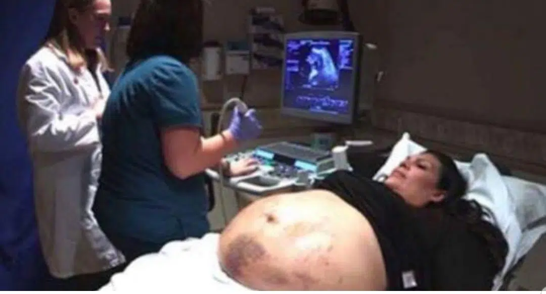 Giovane mamma ha la pancia piena di lividi, i medici guardano l’ecografia e rimangono gelati