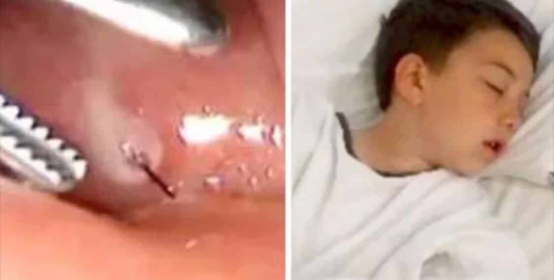 Bimbo sente un fortissimo dolore alla gola, la madre lo porta al pronto soccorso, i medici non riescono a capacitarsi vedendo la radiografia