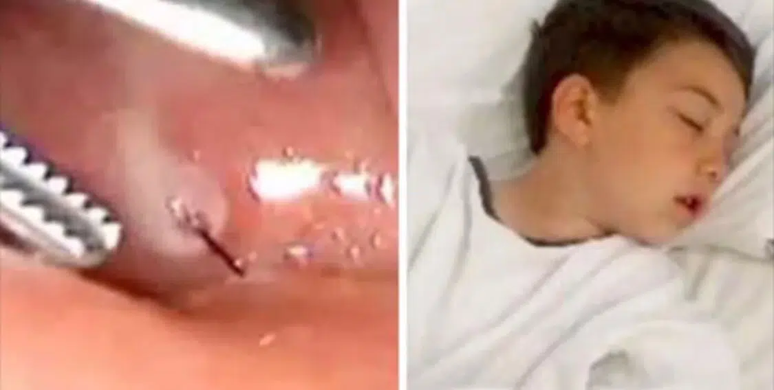 Bimbo sente un fortissimo dolore alla gola, la madre lo porta al pronto soccorso, i medici non riescono a capacitarsi vedendo la radiografia