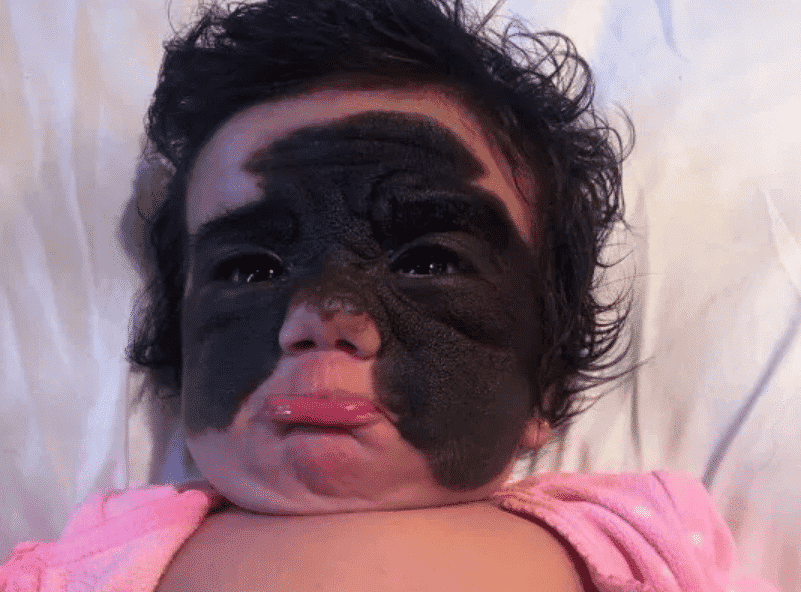 Bambina nasce con una vistosa macchia nera sul viso, quello che dicono alla mamma è terribile