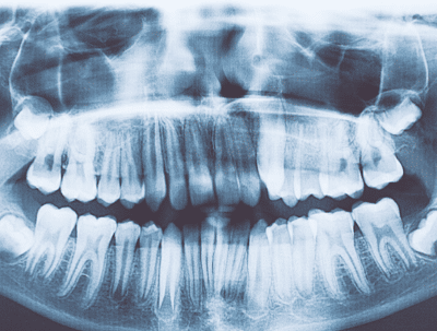 Un bambino di sette anni aveva in bocca più di 500 denti, il video della estrazione è sconvolgente