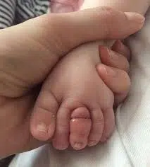 Bambina di pochi mesi piange e non è consolabile, quando la mamma le toglie i calzini vede una cosa sconvolgente