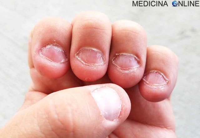 Adolescente mangia le unghie fino a scatenare un cancro della pelle