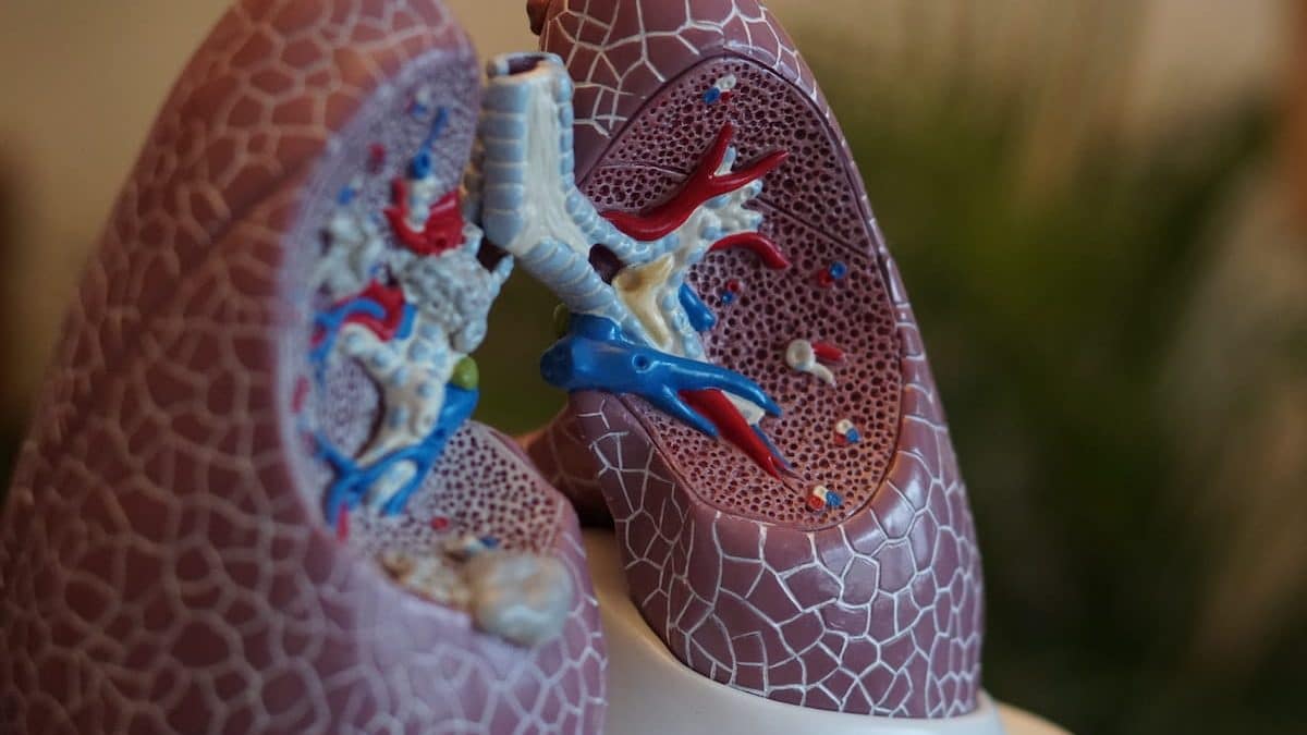 tumore ai polmoni (risorsa del web)