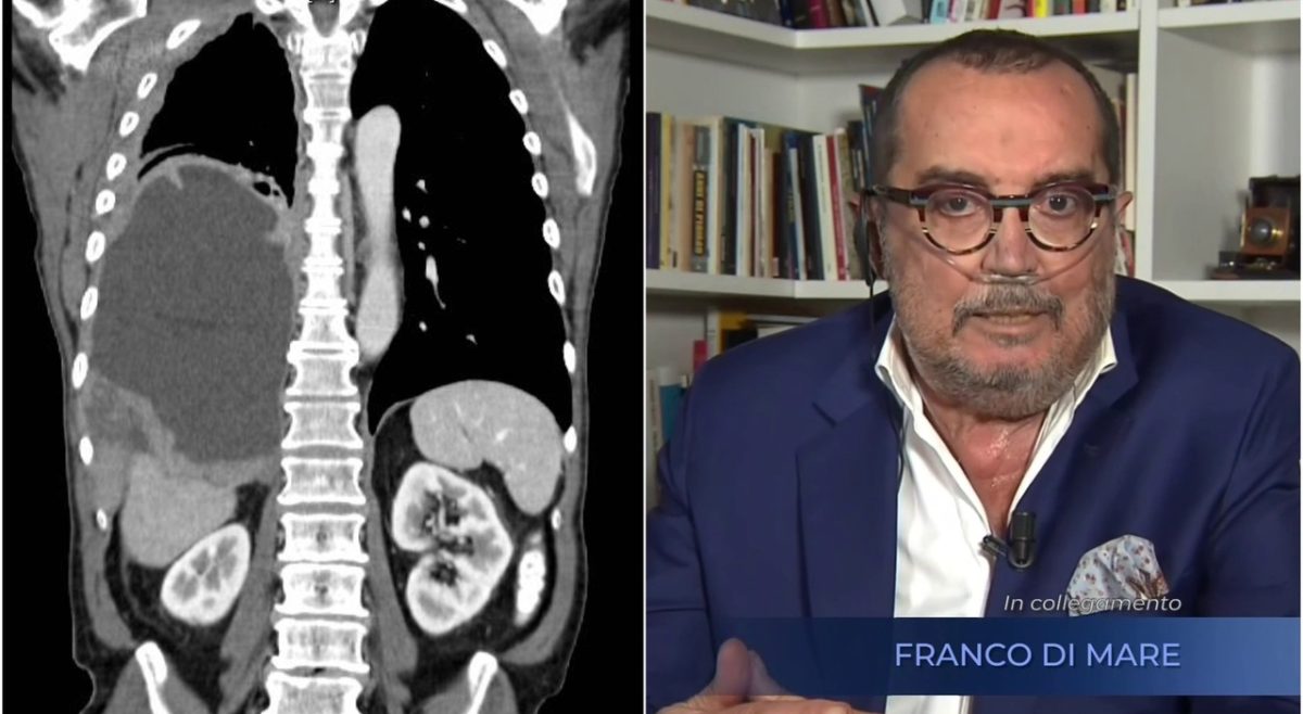 Franco Di Mare affronta una grave malattia con coraggio in diretta televisiva.