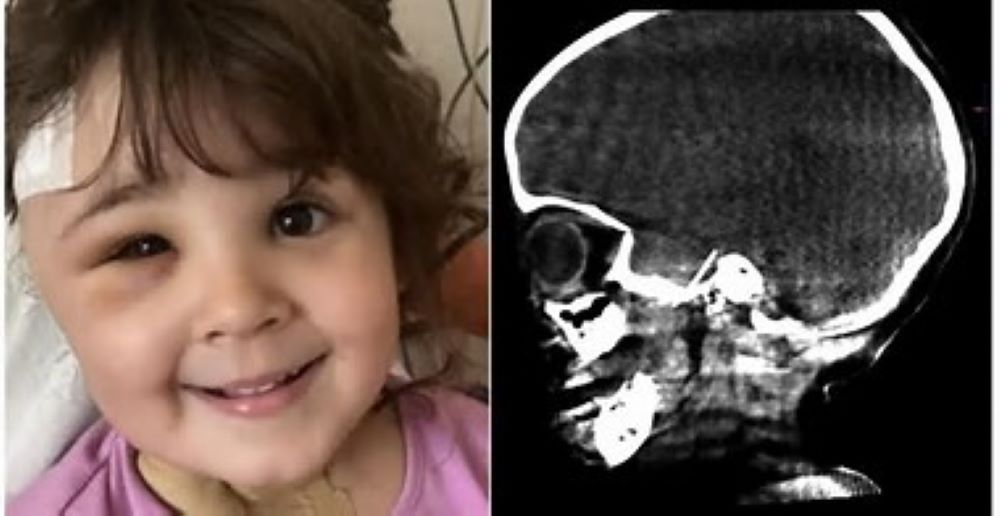 Bambina di 4 anni dal dentista per una carie, ago scivola e arriva al cervello, un’equipe di 22 medici specialisti le salva la vita