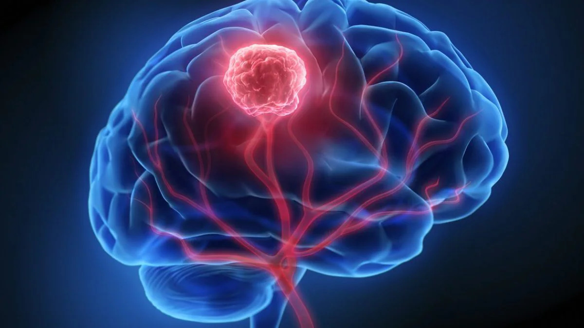 Un trattamento innovativo ha mostrato risultati promettenti contro il tumore cerebrale più aggressivo. Il farmaco sperimentale ha migliorato nettamente le prospettive di sopravvivenza.
