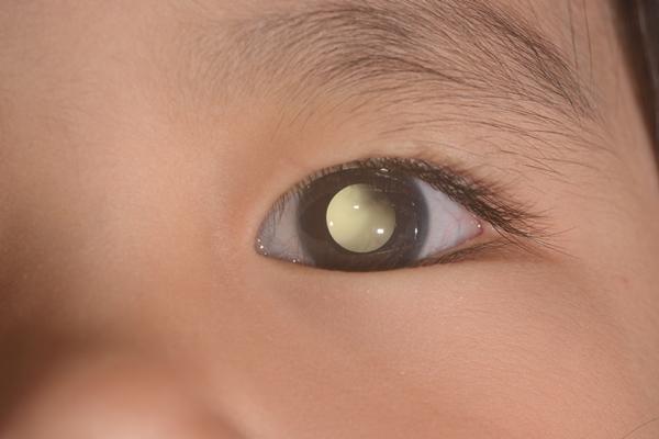 Una foto della figlia prima di dormire le salva la vita: scoperto un raro tumore all’occhio